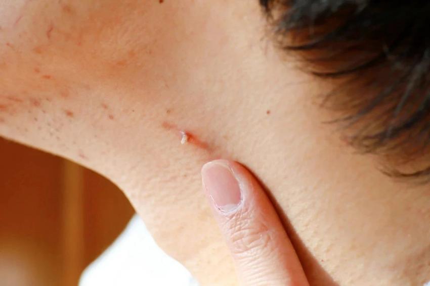 脖子上长“小肉揪”?一文教你认识丝状疣 脖子上长“小肉揪”?一文教你认识丝状疣