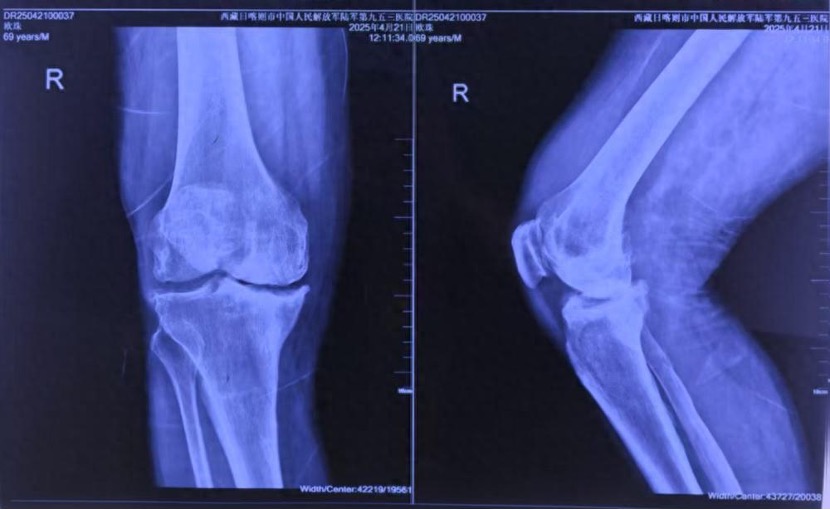 全国首例！ 重庆医生为患者实施机器人辅助生物型全膝关节置换术