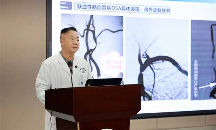 警惕“沉默的脑梗”——慢性脑动脉闭塞，你了解吗？